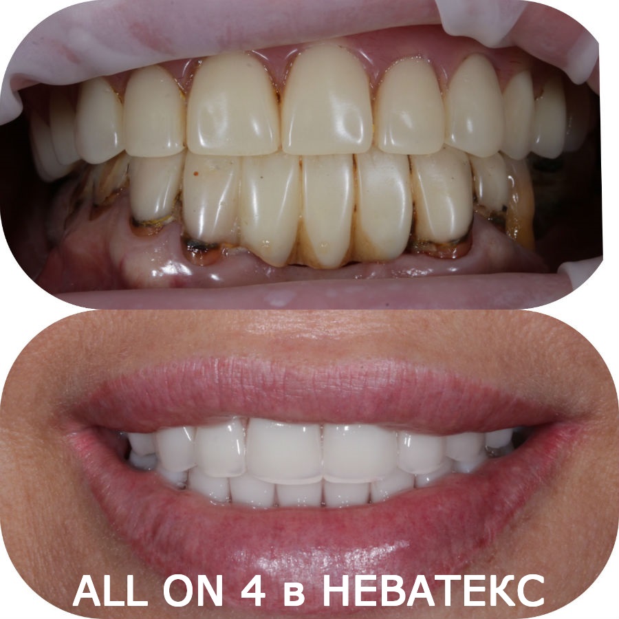 фото отзыв олл он фо зубы до и после фото отзыв олл он фо до и после